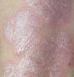 Un risque de psoriasis lié à la consommation de bière ? 